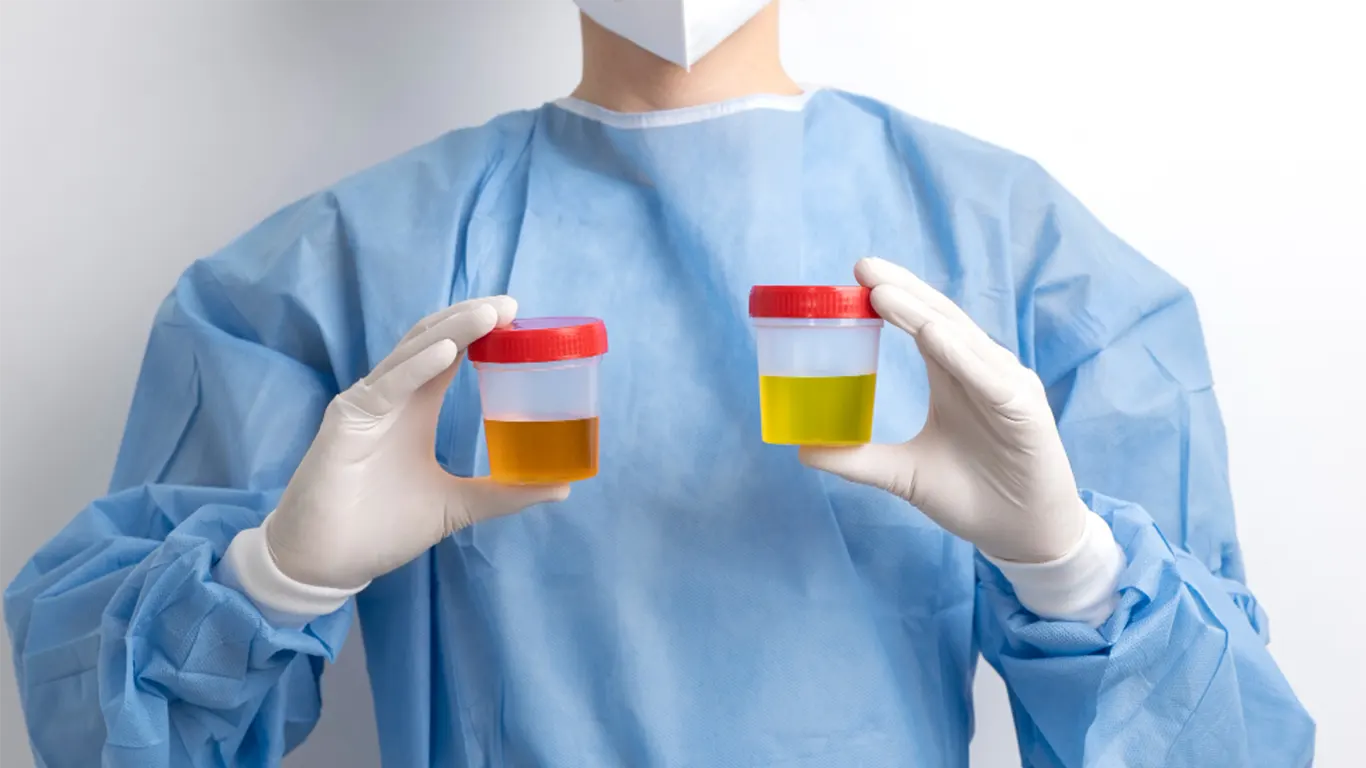 Bacteria en la orina: qué significa y cómo actuar