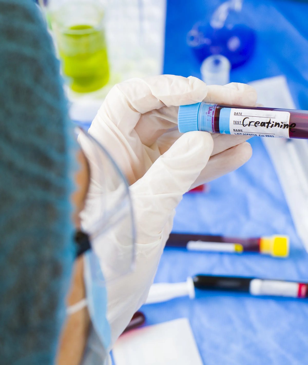Creatinina alta: qué significa y cuándo preocuparse