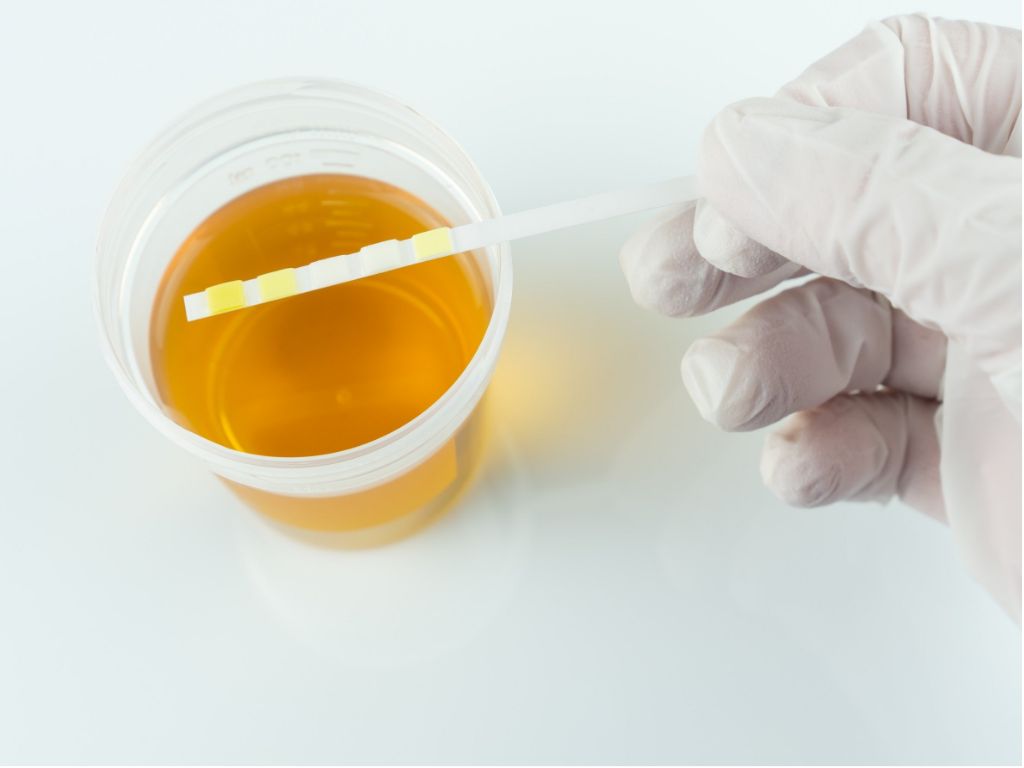 Descubre lo que tu orina dice: La importancia de Detectar proteína en la salud renal